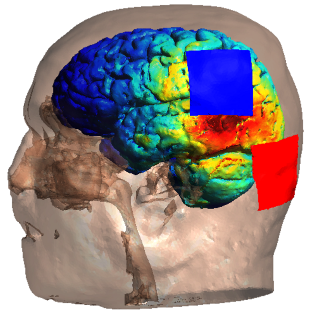 Example of a personalized model for tDCS (transcranial direct current stimulation). This model of the head illustrates how electrical stimulation spreads through the brain. Image: Steven Beumer